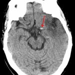 Red arrow: dense proximal left M1 segment indicating thrombus.