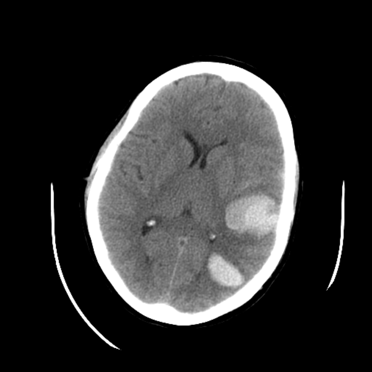 Traumatic Head CT Cases