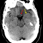 Asymmetrically dense appearance of the proximal left ACA (red arrow) and MCA (yellow arrow) concerning for thrombosis