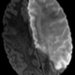 Representative diffusion-weighted MR image from this patient