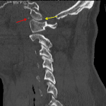 Red arrow: displaced fracture fragments along the anterior aspect of the C1 superior articular facets. Yellow arrow: anterior subluxation of the occipital condyle relative to C1 with widening of the posterior aspect of the atlanto-occipital joint.