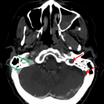 Nonopacification of the left transverse/sigmoid junction and left internal jugular vein on the left (red arrows) compared to the normally opacified vessels on the right (green arrows) indicative of thrombosis