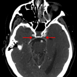 Nonopacification of the cavernous sinus (red arrows).