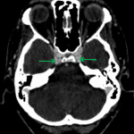 Normally opacified cavernous sinus in a different patient (green arrows).