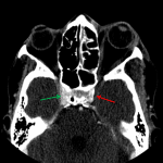 Green arrow: normal contrast density in the right cavernous sinus. Red arrow: lack of normal contrast density in the thrombosed left cavernous sinus.