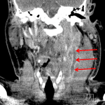 Red arrows: septic thrombophlebitis of the left internal jugular vein. Note overlying muscle thickening and fat stranding.