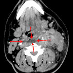 Red arrows: retropharyngeal edema without abscess. This is very important to identify and talk about.