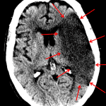 Red arrows: Large left MCA territory infarct.