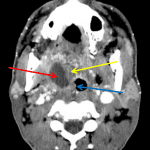 Red arrow: peritonsillar abscess. Yellow arrow: displaced edematous right palatine tonsil. Blue arrow: narrowing of the oropharynx.