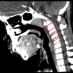 Red arrows: retropharyngeal edema.