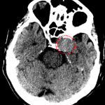 Red dotted circle: left parasellar mass with adjacent bony remodeling.