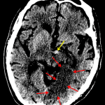 Red arrows: left occipital infarct. Yellow arrow: dense, expanded basilar tip