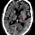 Red arrow: left thalamic infarct