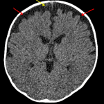 Red arrows: enlarged bifrontal subarachnoid spaces. Yellow arrow: example of a bridging cortical vein
