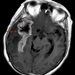 Red arrow: postcontrast brain MR image showing the peripherally enhancing, centrally necrotic tumor, likely a glioblastoma