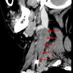 Red arrows: catheter-associated septic thrombophlebitis of the right internal jugular vein.