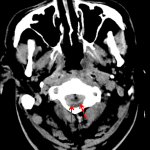 Red arrows show the dorsal margin of a peripherally enhancing upper cervical epidural collection concerning for abscess