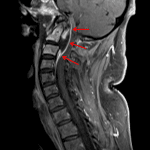 Red arrows again show the dorsal margin of this collection on the patient's subsequent C spine MRI. Note the enhancement of the C2 and C3 vertebral bodies, which is concerning for osteomyelitis