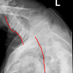 Red lines trace the anterior vertebral line in the cervical and thoracic spine. Note the huge gap between the two.