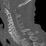 Corresponding CT in case you don't believe the x-ray. There are multiple small fractures that would have been impossible to pick up on the radiograph.