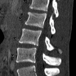 Acute T12 and L2 compression fractures (note the dense band paralleling the L2 superior endplate consistent with trabecular impaction).