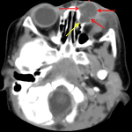 Red arrows: infected dacryocystocele with surrounding inflammatory changes. Yellow arrow: communication posteriorly with the nasolacrimal duct.