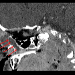 Red arrows: dilated proximal and mid nasolacrimal duct with distal tapering.