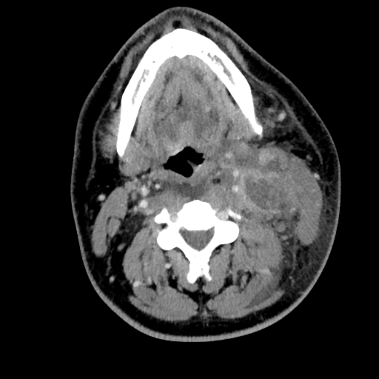 Head & Neck CT Cases