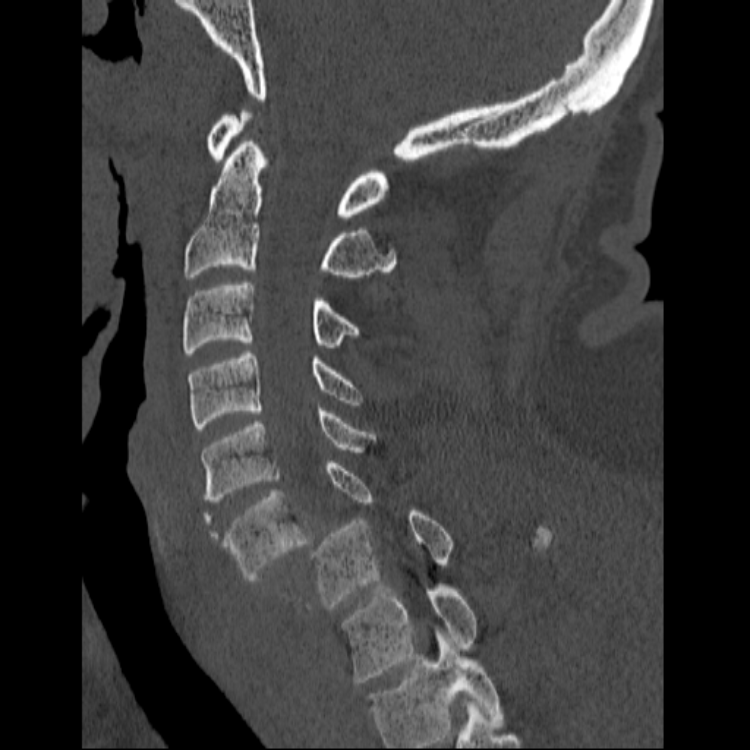 Spine CT Cases