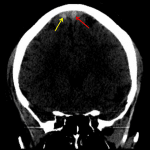High density thrombus in the superior sagittal sinus (red arrow) as well as in an adjacent cortical vein (yellow arrow)