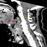 Red arrow: edematous epiglottis. Yellow arrow: possible abscess along the posterior hypopharyngeal wall.