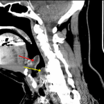 Edematous epiglottis (red arrow) and aryepiglottic fold (yellow arrow).