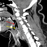 Normal epiglottis (red arrow) and aryepiglottic fold (yellow arrow).