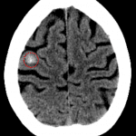 Red dotted circle: hemorrhagic metastasis at the gray-white junction in the right frontal lobe