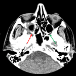 Red arrow: abnormal soft tissue density in the pterygopalatine fossa representing invasive fungal sinusitis. Green arrow: normal fat in the left pterygopalatine fossa.