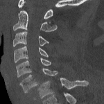 Severe traumatic anterolisthesis. Try to imagine what the cord must look like.