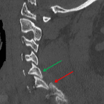 Green arrow: normal facet alignment at C5-C6. Red arrow: jumped facet with the inferior articulating facet of C6 ANTERIOR to the superior articulating facet of C7.