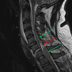 Green arrows show normal cord thickness above and below the level of injury with severe cord narrowing (red arrow) at the level of injury. The patient is now s/p reduction, but is paralyzed.