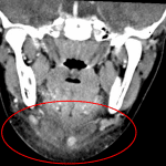 Red oval: subcutaneous fat stranding and edema in the submandibular and submental spaces extending into the sublingual space.