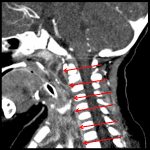 Red arrows: extension of infection through the retropharyngeal space.