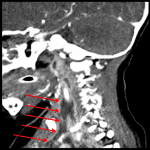 Red arrows: extension of infection through the carotid space.