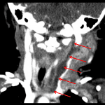 Red arrows: fluid extending inferiorly through the carotid sheath separating the carotid artery (medially) from the internal jugular vein (laterally). Note the mass effect on the internal jugular vein.