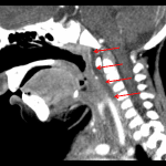 Red arrows: retropharyngeal edema.