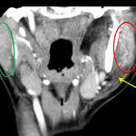 Green circle: normal right parotid gland. Red circle: enlarged, hyperenhancing left parotid gland consistent with parotiditis. Yellow arrows: adjacent fat stranding.