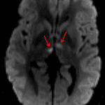 Corresponding diffusion-weighted image from the patient's MRI showing acute bilateral thalamic infarcts