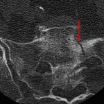 Red arrows: left sacral fractures extending into the left S1 neural foramen.