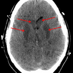 Red arrows: gray-white reversal in the basal ganglia where the gray matter looks darker than the white matter