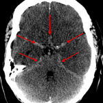 Red arrows: pseudosubarachnoid hemorrhage in a companion case