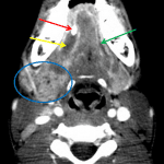Blue circle: enlarged hyperenhancing right submandibular gland. Note the normal left submandibular gland. Red arrow: obstructing sialolith. Yellow arrow: dilated right Wharton's duct. Green arrow: nondilated left Wharton's duct for comparison.