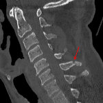 Red arrow: minimally displaced C6 spinous process fracture.